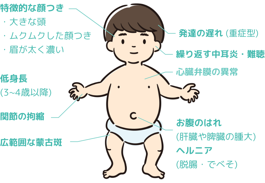 ムコ多糖症Ⅱ型について｜教えて！ムコタ先生〜ムコ多糖症相談室〜